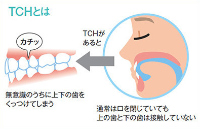 TCH:Tooth Contactin Habit