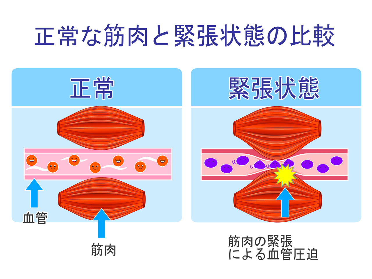 血行不良による頭痛