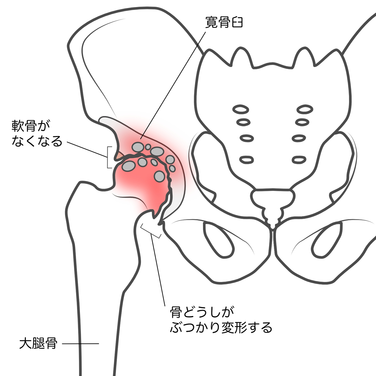 変形性股関節症