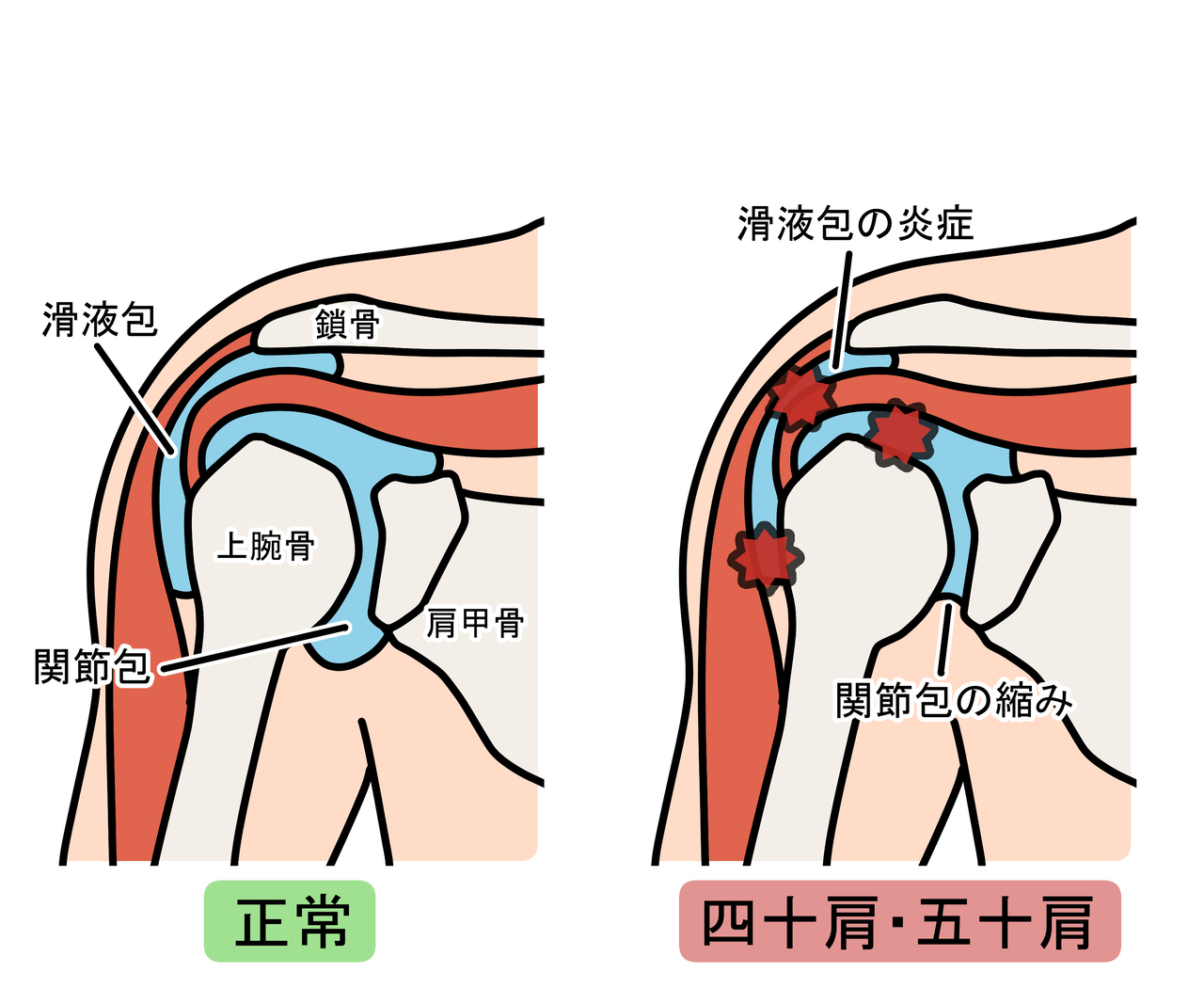 五十肩・四十肩